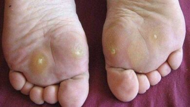 Forma eficaz de eliminar calos dos pés rapidamente