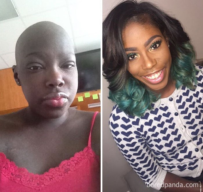 1750445355 560 10 antes e depois de pessoas que venceram o cancer