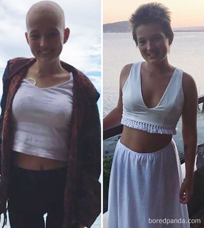 1750445362 520 10 antes e depois de pessoas que venceram o cancer