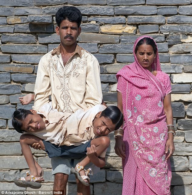 Gêmeos siameses de 12 anos