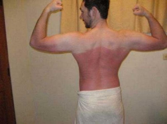 2-18-pessoas-que-esqueceram-o-quanto-as-marcas-de-sol-podem-ser-constrangedoras-as-vezes