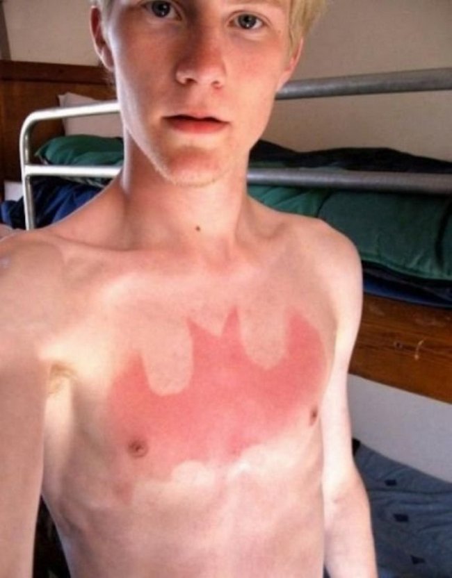 4-18-pessoas-que-esqueceram-o-quanto-as-marcas-de-sol-podem-ser-constrangedoras-as-vezes