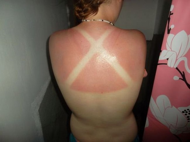 7-18-pessoas-que-esqueceram-o-quanto-as-marcas-de-sol-podem-ser-constrangedoras-as-vezes