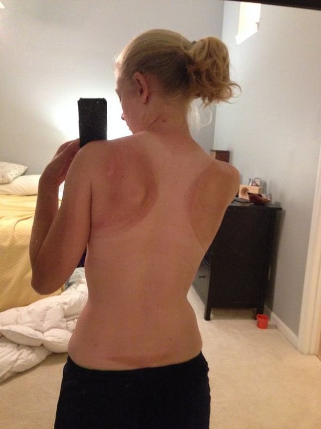 9-18-pessoas-que-esqueceram-o-quanto-as-marcas-de-sol-podem-ser-constrangedoras-as-vezes