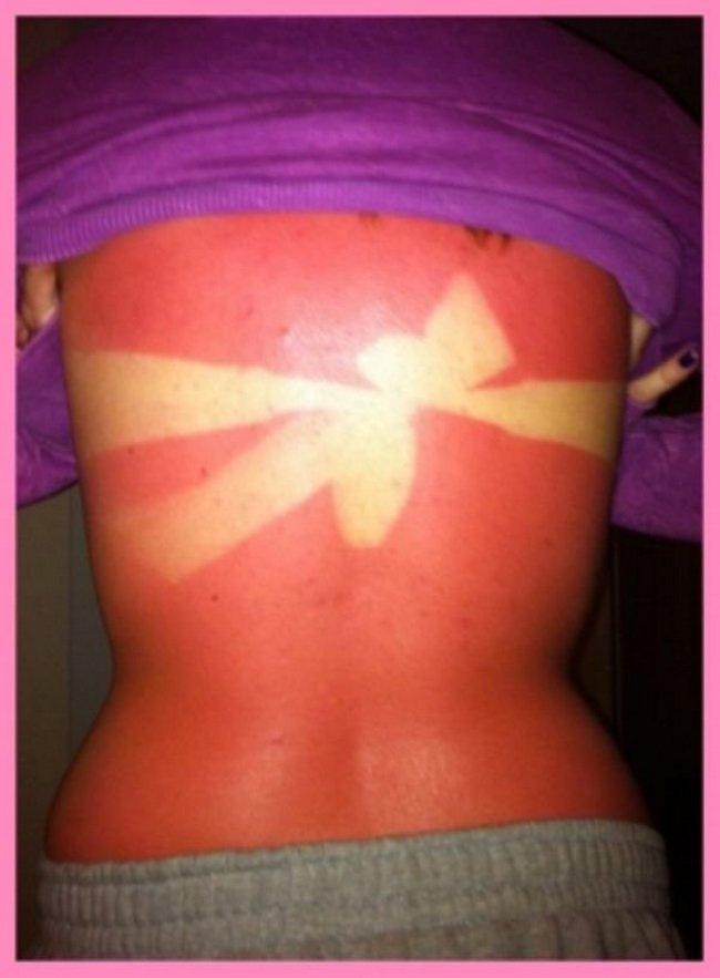 13-18-pessoas-que-esqueceram-o-quanto-as-marcas-de-sol-podem-ser-constrangedoras-as-vezes