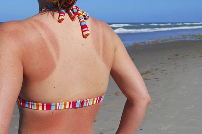 16-18-pessoas-que-esqueceram-o-quanto-as-marcas-de-sol-podem-ser-constrangedoras-as-vezes