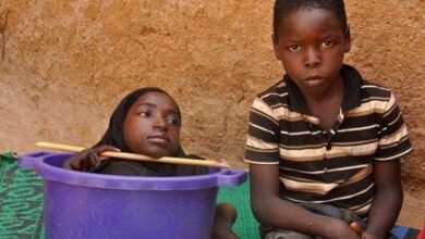 A história triste da garota sem membros que vive em uma bacia