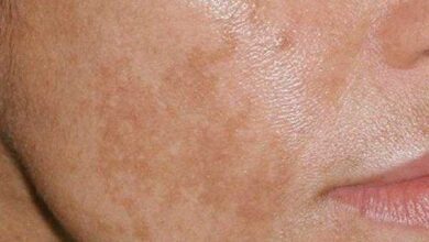 como acabar com manchas no rosto