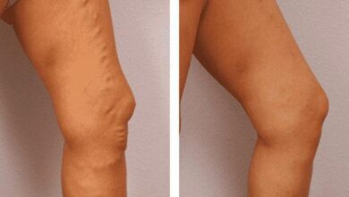 Receita de babosa para curar varizes e reativar circulação do sangue