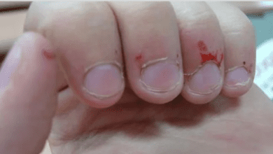 1750549991 onicofagia compulsao em roer unhas e sinal de alerta Onicofagia: Compulsão em roer unhas é sinal de alerta!