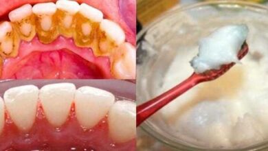 Elimine o tártaro e a placa bacteriana com essa receita caseira