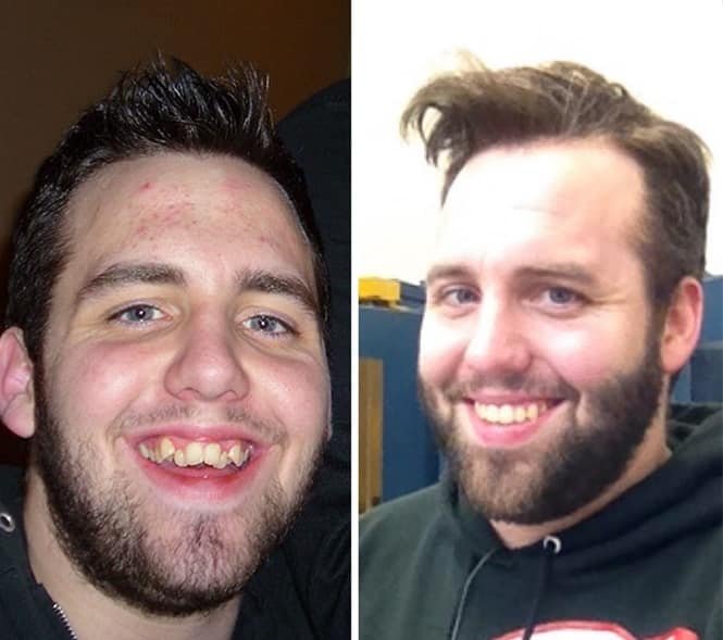 20 transformações quase inacreditáveis de pessoas que tinham dentes fora do lugar