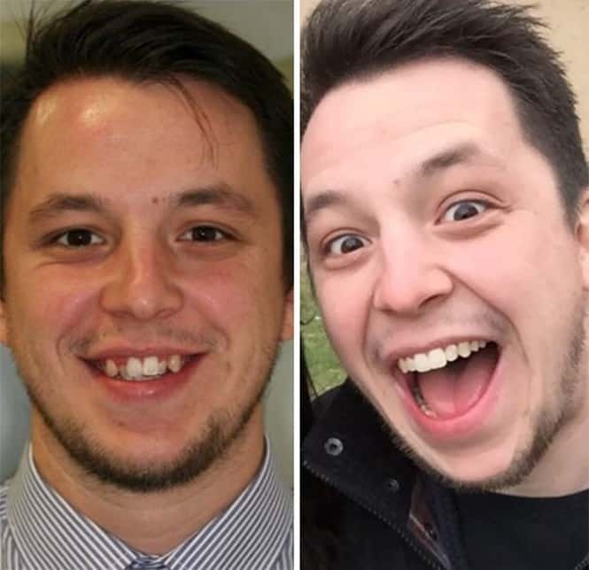 20 transformações quase inacreditáveis de pessoas que tinham dentes fora do lugar