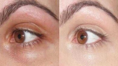 Receita de bicarbonato de sódio para manchas em volta dos olhos