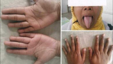 8 sinais de deficiência de vitamina B12 e como tratar o problema