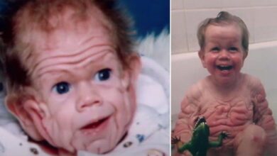 Lembra dele? 'Menino mais enrugado do mundo' está com 28 anos e virou um belo rapaz