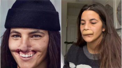 Modelo que perdeu lábio superior após ataque de pitbull mostra resultado de cirurgia reparadora: 'Muito grata'