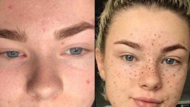 Tatuar sardas na face é nova mania de beleza