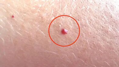 se você tem essas pintas no corpo, saiba por que esse é um problema que não pode ser ignorado