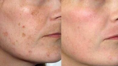 Como fechar os poros do rosto: 6 receitas caseiras