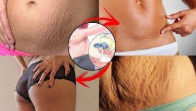 Cebola para eliminar estrias e cicatrizes. FANTÁSTICO!