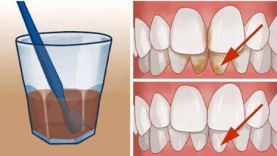 Este remédio vai te ajudar a se livrar de manchas feias de tártaro de seus dentes