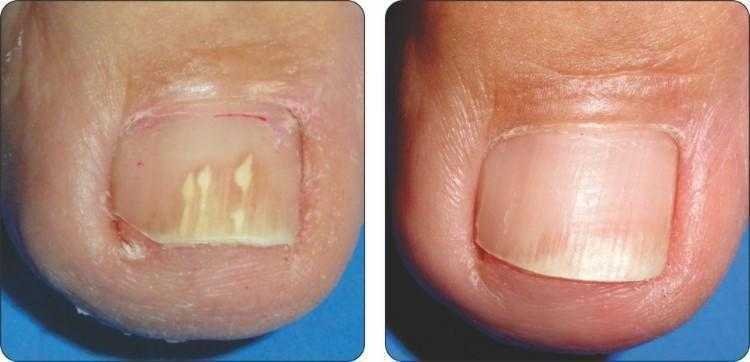 3 Dicas de como eliminar os fungos das unhas 3 Dicas de como eliminar os fungos das unhas d q