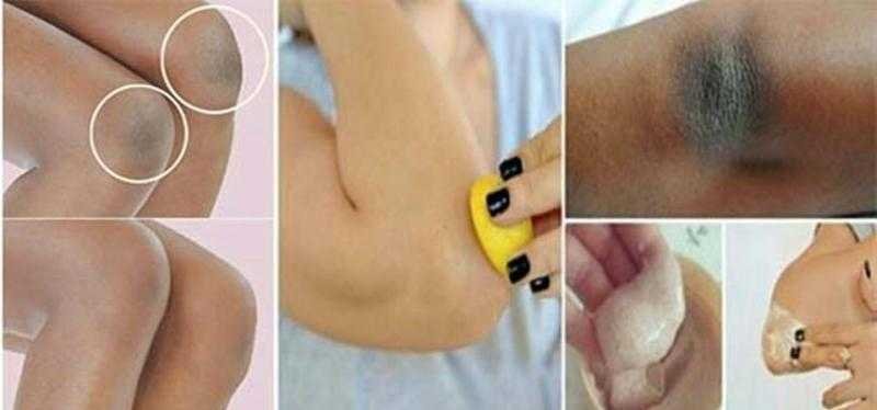 3 Receitas caseiras para clarear cotovelos e joelhos dd