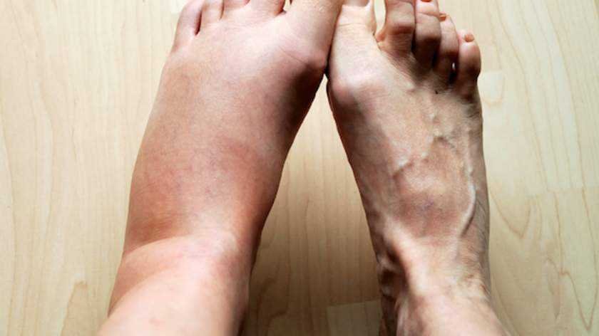 4 Sinais nos seus pes podem indicar se voce corre 4 Sinais nos seus pés podem indicar se você corre o risco de um infarto ou AVC. Saiba identificar