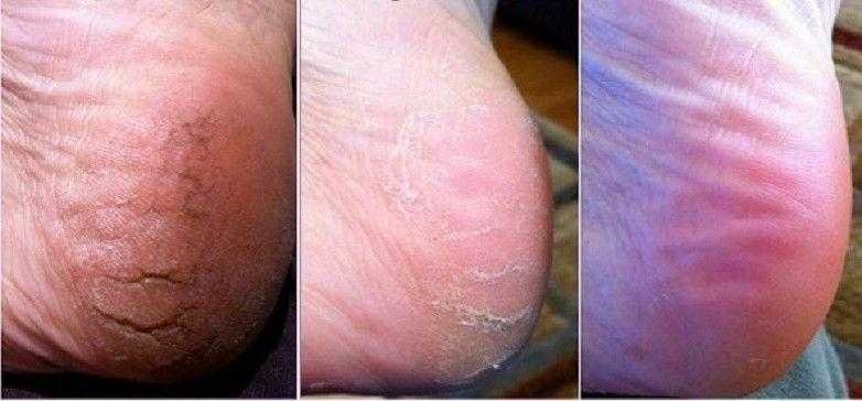 4 remedios caseiros simples para rachaduras nos pes 4 remédios caseiros simples para rachaduras nos pés 4q