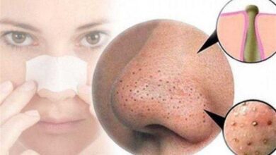 5 máscaras faciais para remover os cravos A