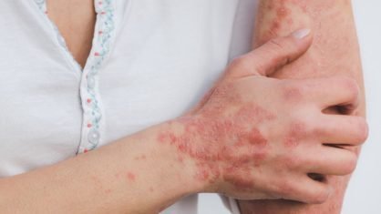 5 remedios totalmente naturais para acabar com eczema psoriase e