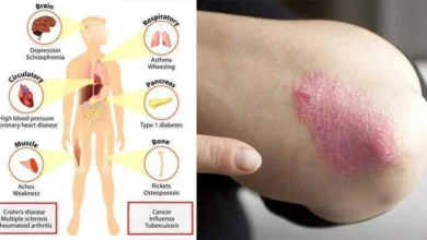 5 sinais de deficiência de vitamina D que não devemos ignorar!