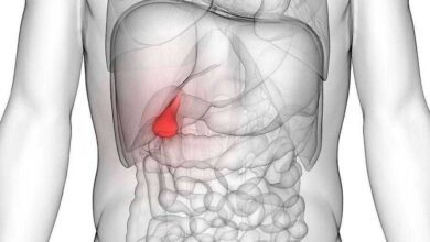 6 sinais de que você está sofrendo com pedras na vesícula