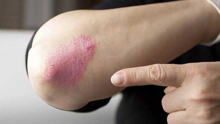 7 Dicas de Cuidados para Pele com Psoriase 7 dicas de cuidados para pele com psoríase