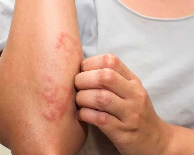 9 sinais de que seu corpo esta com excesso de 9 Sinais de que seu corpo está com excesso de toxinas