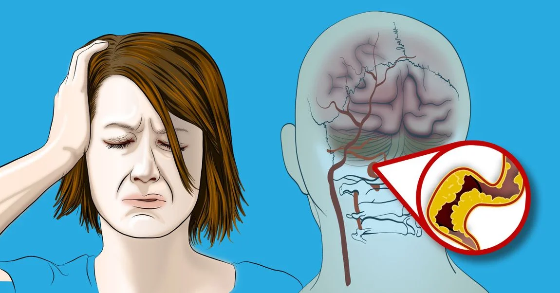 9 sinais incomuns de avc em mulheres que ninguém fala