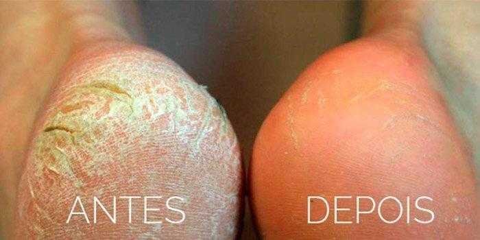 Acabe com as rachaduras nos pes com aspirina Acabe com as rachaduras nos pés com aspirina