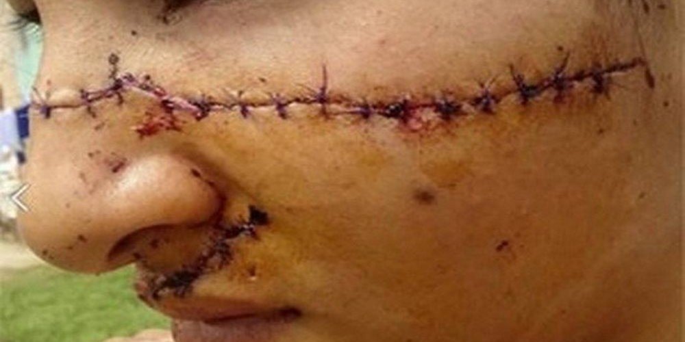 Adolescente tem rosto desfigurado por vizinhas que a achavam bonita