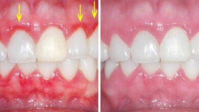 Aprenda a tratar da gengivite de modo caseiro