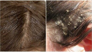 Aprenda como se livrar das caspas Aprenda como se livrar das caspas