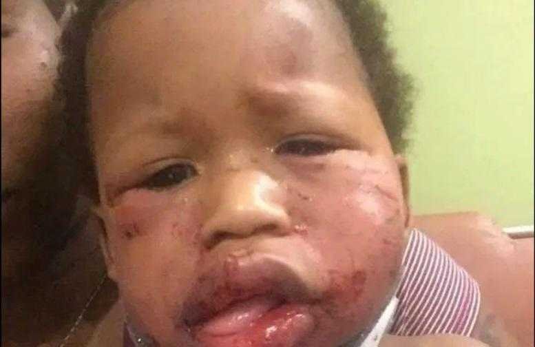 Bebe e agredido na creche mae mostra machucados e desabafa blank