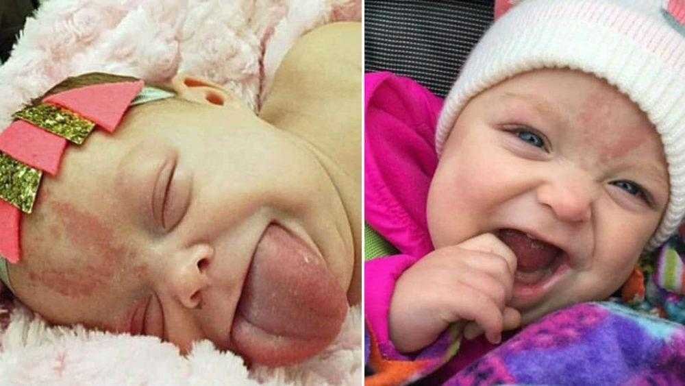 Bebe que nasceu com lingua gigante sorri pela 1a vez Bebê que nasceu com língua gigante sorri pela 1ª vez após cirurgia Q