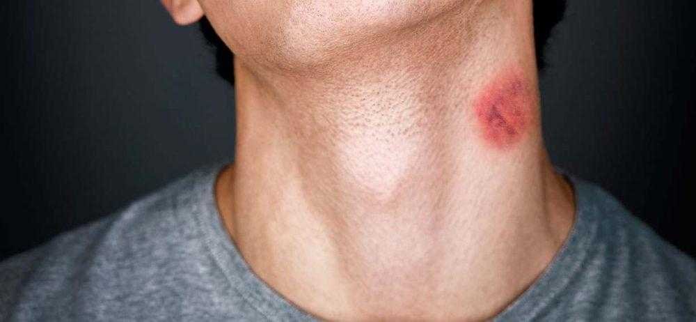 Chupões podem ser fatais. Entenda por quê Chupões podem ser fatais. Entenda por quê