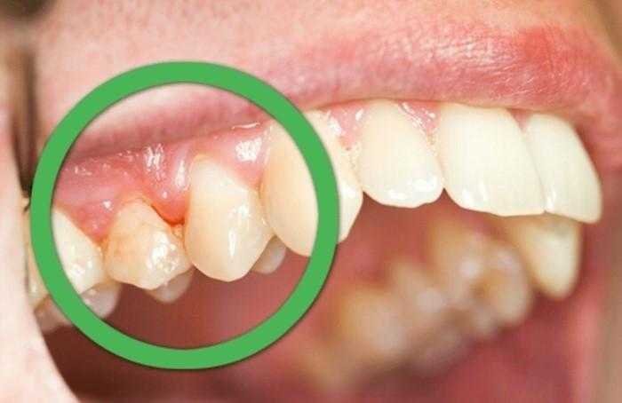 Como Curar Gengivite Naturalmente Bau das DICAS Como Curar Gengivite Naturalmente