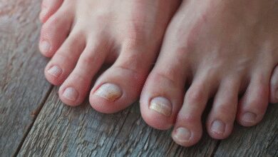 como eliminar fungos nas unhas dos pés e mãos