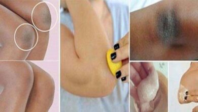 Como resolver de vez o problema de axilas, joelhos e cotovelos escuros!