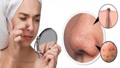 Como tirar cravos pretos do rosto Como tirar cravos pretos do rosto