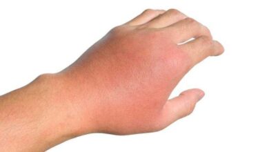 Como tratar picada de abelha com segurança