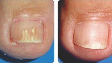 Elimine rapidamente os fungos dos pés e das mãos com essa receita